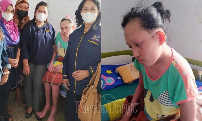 Kondisi Remaja yang Kulitnya Melepuh Pasca Vaksinasi di Makale, Membaik dan Diperbolehkan Pulang dari RS